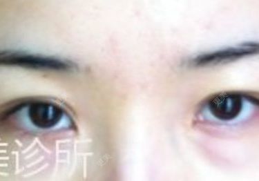 双眼皮