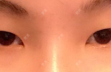 双眼皮
