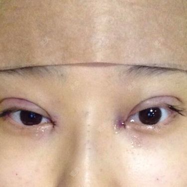 双眼皮