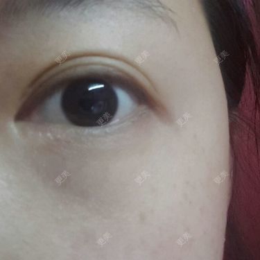 双眼皮