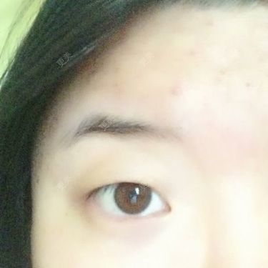 双眼皮
