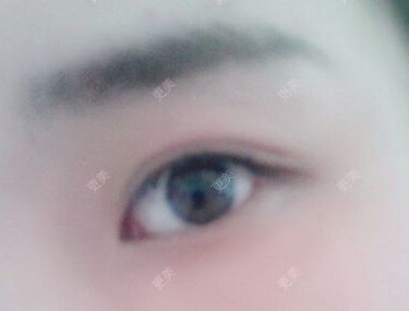 双眼皮