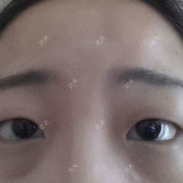 双眼皮