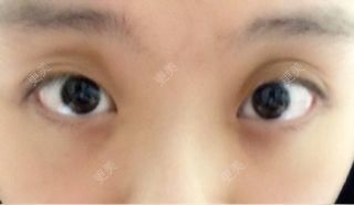 双眼皮