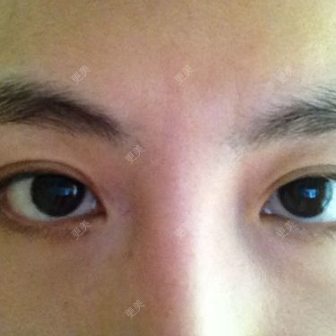 双眼皮