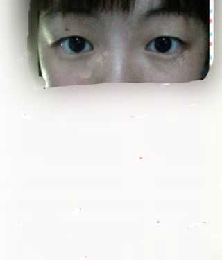 双眼皮