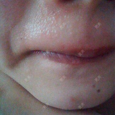 面部脱毛