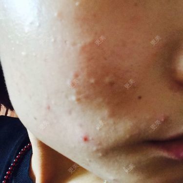 祛疤痕痘印