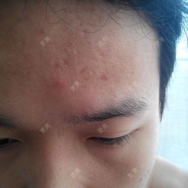 痘痘和痘印额头上和两边脸颊都有这样的痘痘长了2年多了求专家帮我