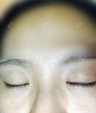 双眼皮