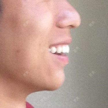 牙齿整形