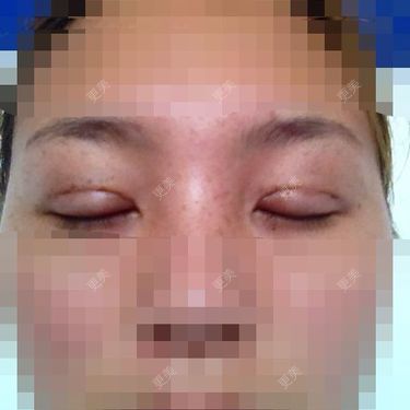 双眼皮