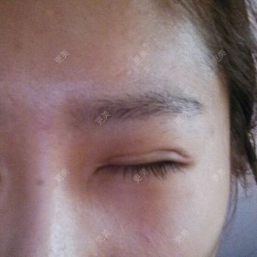 双眼皮