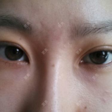 双眼皮
