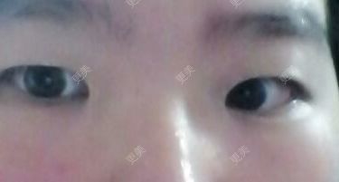 双眼皮