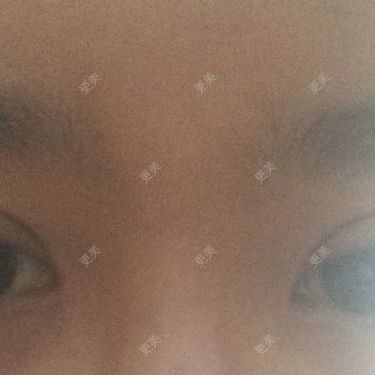 双眼皮