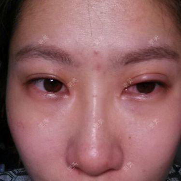 双眼皮