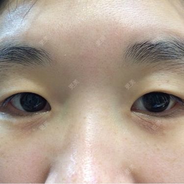 双眼皮