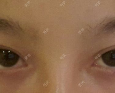 双眼皮