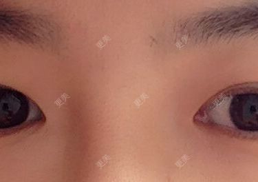 双眼皮