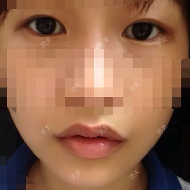 牙齿整形