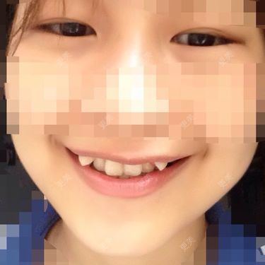 牙齿整形