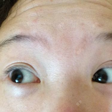 做了双眼皮手术后变成三眼皮了怎么办那个褶子是我原来内双的褶子当时