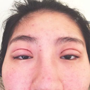 双眼皮第二天我的眼睛肿的长不开了好像没睡醒这是正常的吗会肿几天呀