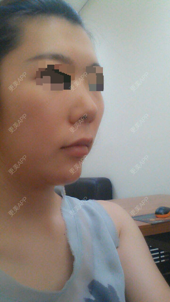 更美 - 是需要颧骨内推吗？ | 颧骨颧弓 | 佛山
