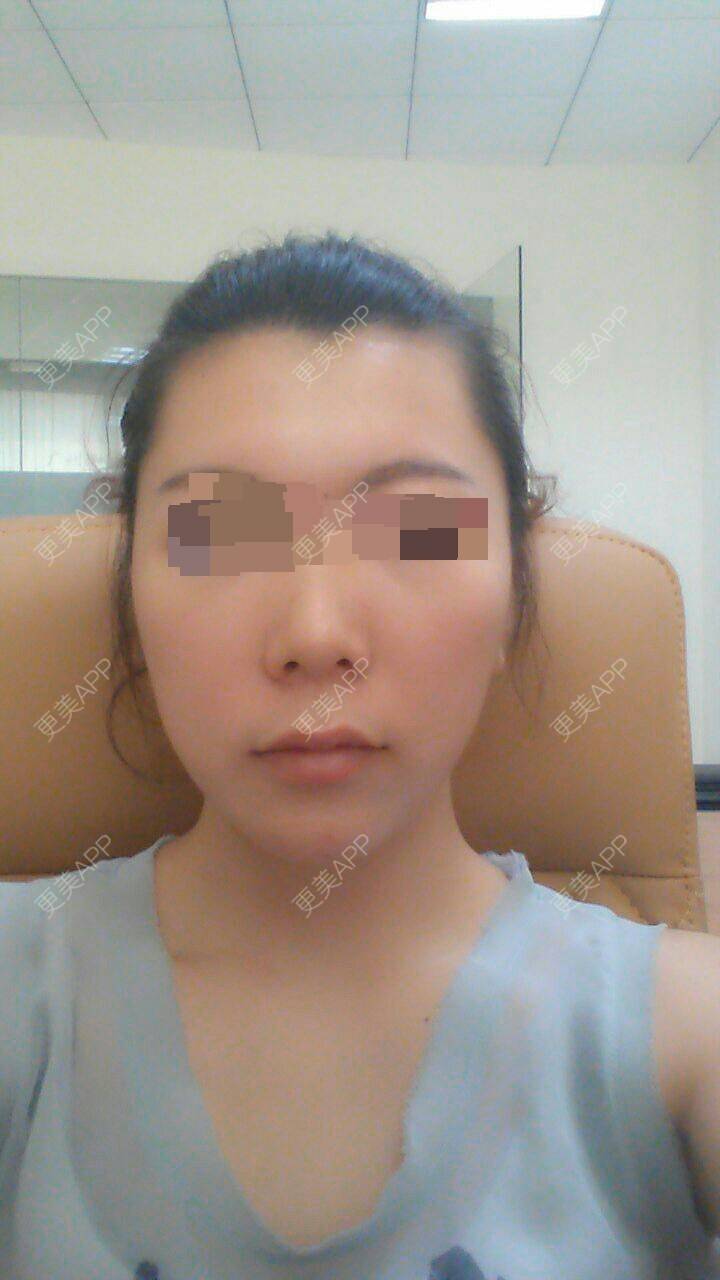 更美 - 是需要颧骨内推吗？ | 颧骨颧弓 | 佛山