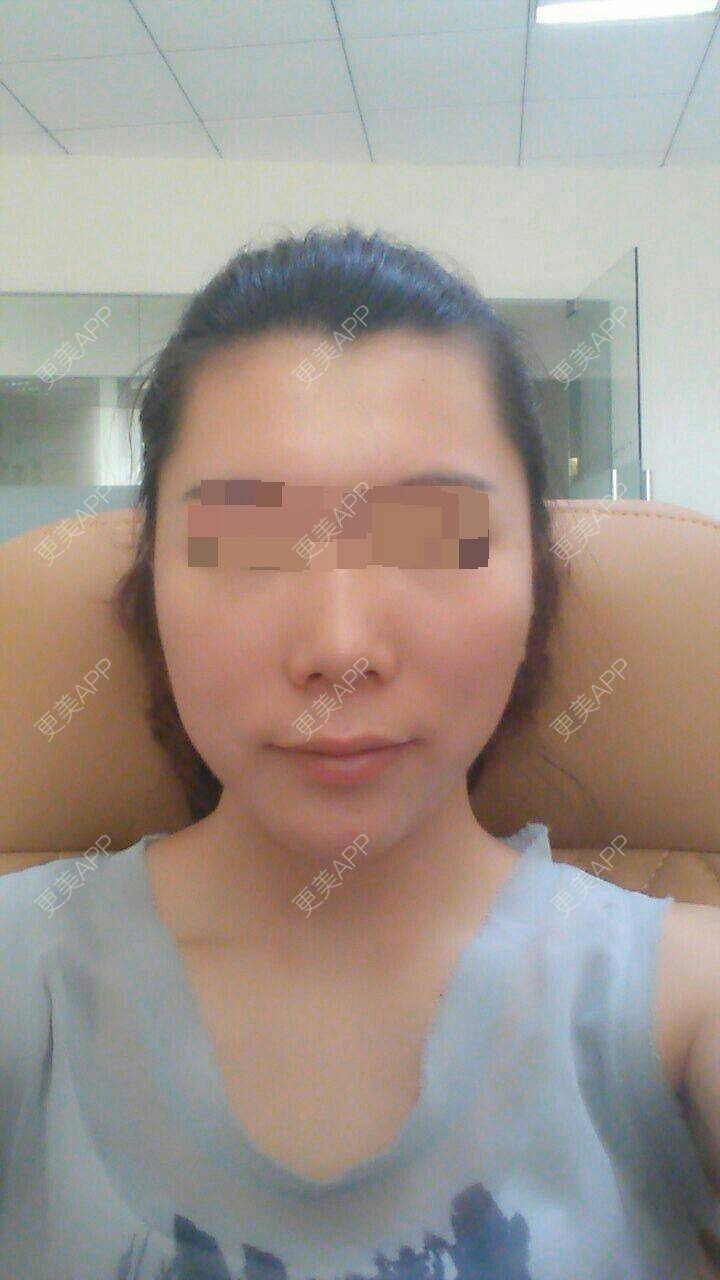 更美 - 是需要颧骨内推吗？ | 颧骨颧弓 | 佛山