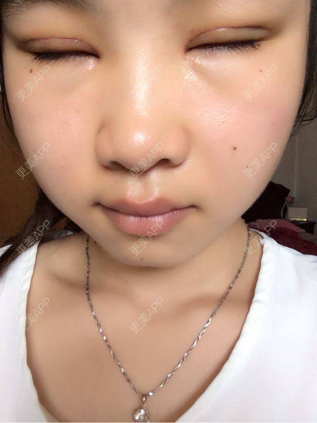 直播全切双眼皮加开眼角