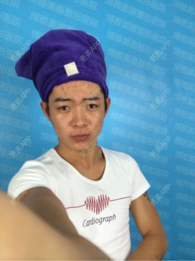 更美 - 咨询一下国内有换皮技术吗？ | 祛疤痕痘印 | 台州