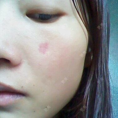 小时候不明显,等我19岁,05年读高中时,脸上这个血管痣就很明显了,去