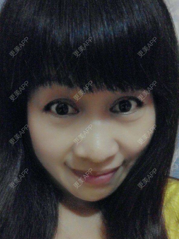 更美 - 我的眼袋很大，想做掉，又不知做什么手续效果好，而且没副作用，请问哪位朋友做过推荐个好的医院或者好的医生 | 祛眼袋 | 江门