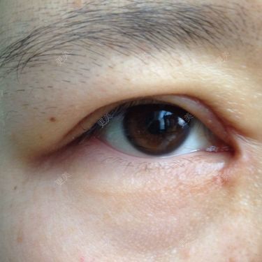 一个月前开的眼角现在眼角的疤越来越明显在八大处做的这疤现在超明显