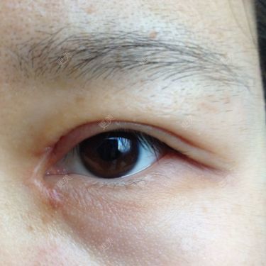 一个月前开的眼角现在眼角的疤越来越明显在八大处做的这疤现在超明显