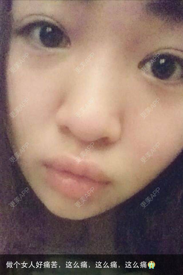 更美 - 大家进来看看，帮新来的出出主意呗！ | 隆鼻 | 台州