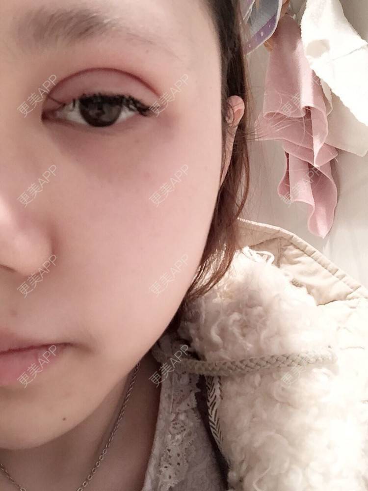 微创双眼皮肿泡眼的日记