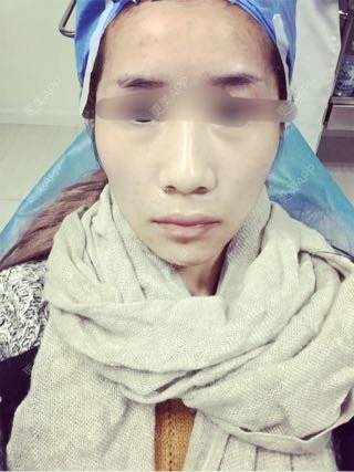 更美 - 今天冲动说做就做的破尿酸丰太阳穴 | 太阳穴 | 深圳