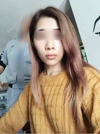 更美 - 今天冲动说做就做的破尿酸丰太阳穴 | 太阳穴 | 深圳