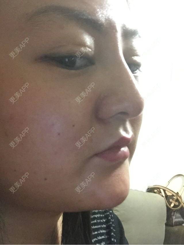 更美 - 玻尿酸丰下巴+玻尿酸填充泪沟+玻尿酸注射隆鼻+瘦脸针的日记p | 玻尿酸泪沟 | 除皱瘦脸 | 玻尿酸苹果肌 | 玻尿酸下巴 | 信阳