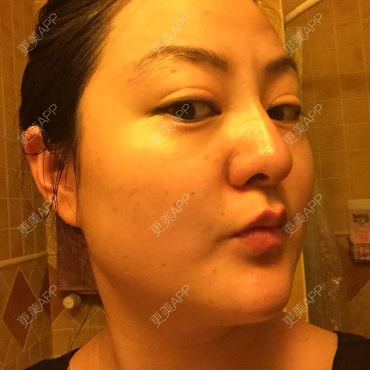 更美 - 玻尿酸丰下巴+玻尿酸填充泪沟+玻尿酸注射隆鼻+瘦脸针的日记p | 玻尿酸泪沟 | 除皱瘦脸 | 玻尿酸苹果肌 | 玻尿酸下巴 | 信阳