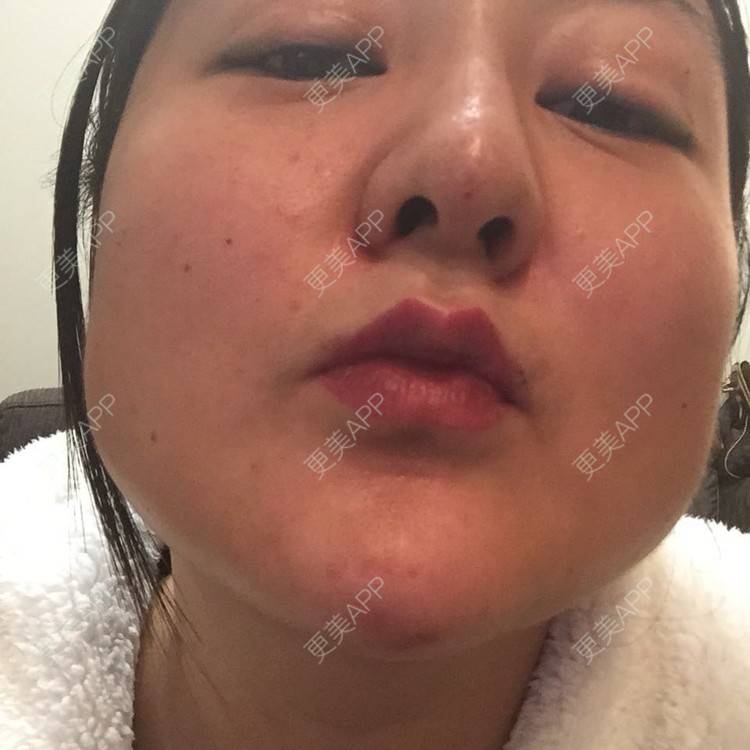 更美 - 玻尿酸丰下巴+玻尿酸填充泪沟+玻尿酸注射隆鼻+瘦脸针的日记p | 玻尿酸泪沟 | 除皱瘦脸 | 玻尿酸苹果肌 | 玻尿酸下巴 | 信阳