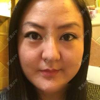 更美 - 玻尿酸丰下巴+玻尿酸填充泪沟+玻尿酸注射隆鼻+瘦脸针的日记p | 玻尿酸泪沟 | 除皱瘦脸 | 玻尿酸苹果肌 | 玻尿酸下巴 | 信阳