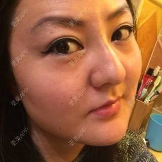 更美 - 玻尿酸丰下巴+玻尿酸填充泪沟+玻尿酸注射隆鼻+瘦脸针的日记p | 玻尿酸泪沟 | 除皱瘦脸 | 玻尿酸苹果肌 | 玻尿酸下巴 | 信阳