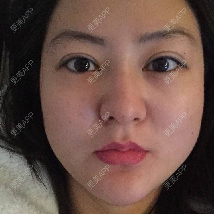 更美 - 玻尿酸丰下巴+玻尿酸填充泪沟+玻尿酸注射隆鼻+瘦脸针的日记p | 玻尿酸泪沟 | 除皱瘦脸 | 玻尿酸苹果肌 | 玻尿酸下巴 | 信阳