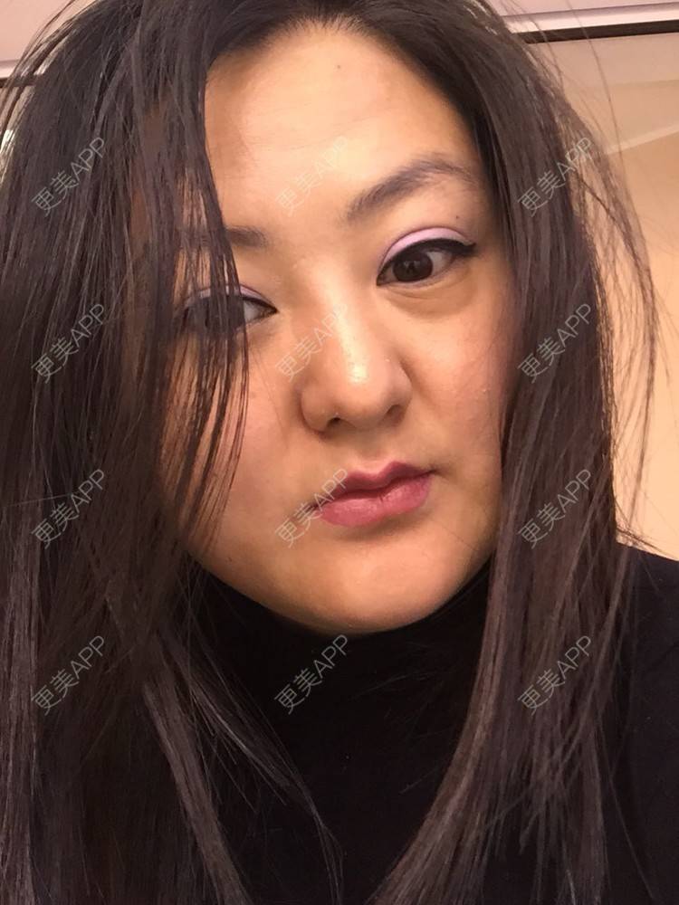 更美 - 玻尿酸丰下巴+玻尿酸填充泪沟+玻尿酸注射隆鼻+瘦脸针的日记p | 玻尿酸泪沟 | 除皱瘦脸 | 玻尿酸苹果肌 | 玻尿酸下巴 | 信阳