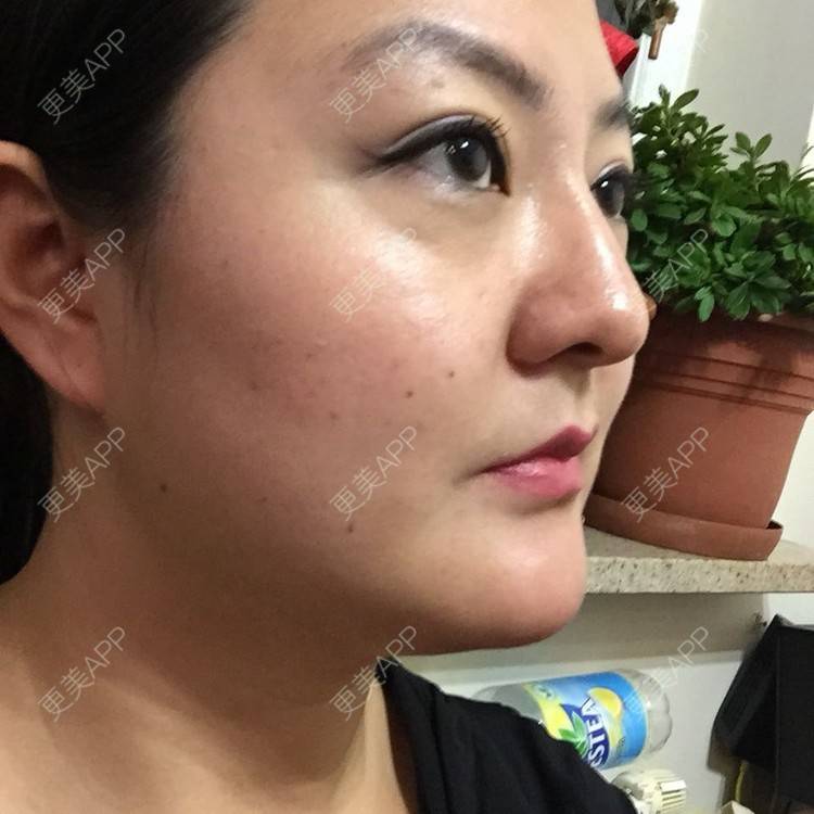 更美 - 玻尿酸丰下巴+玻尿酸填充泪沟+玻尿酸注射隆鼻+瘦脸针的日记p | 玻尿酸泪沟 | 除皱瘦脸 | 玻尿酸苹果肌 | 玻尿酸下巴 | 信阳