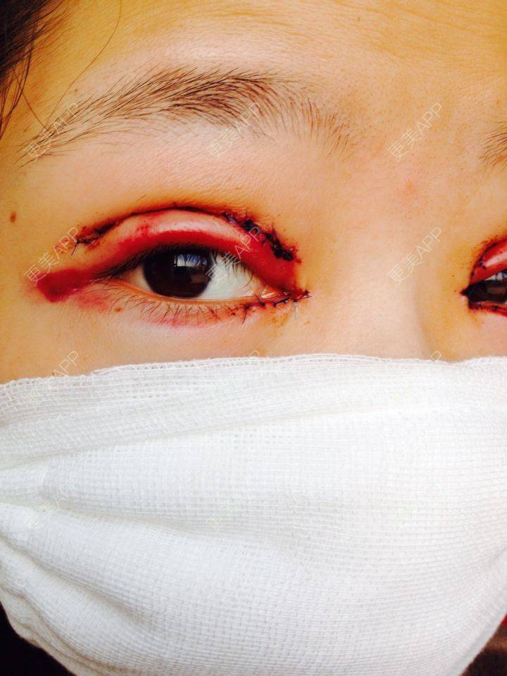 直播啦今天刚做的双眼皮新鲜出炉一起来见证我的双眼皮之路吧